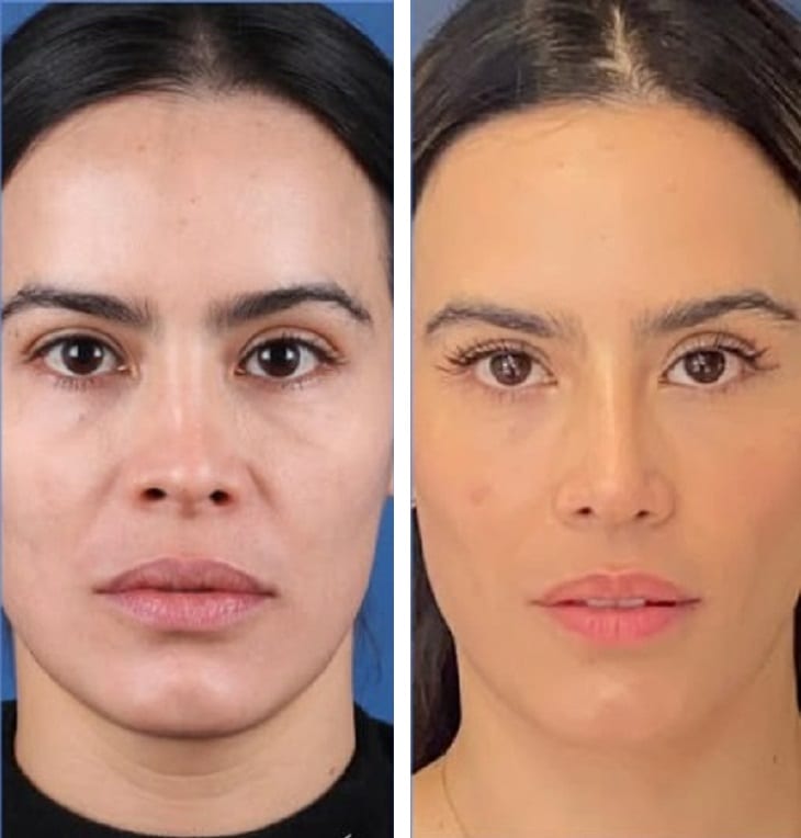 Rinoplastia caso 5 — antes y después